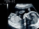Cysta na jajniku podczas ciąży